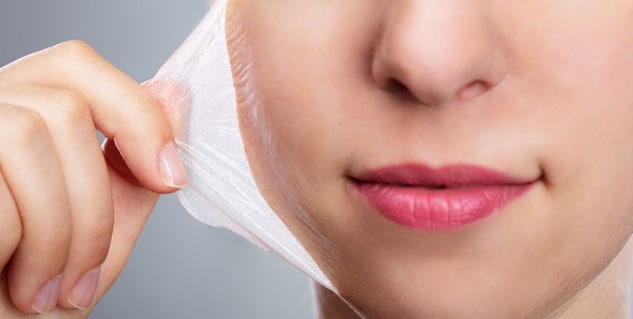 Chemical Peels Treatment