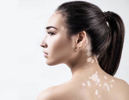 Masters Course in Vitiligo Surgery (MCVS)